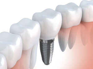 更年期で歯がボロボロに？歯の痛み・歯ぐきの腫れ・歯の脆弱化の原因と治療法