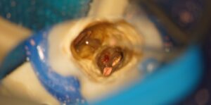 東京の根管治療専門外来、笠原デンタルオフィスで、「噛むと痛い」は歯根膜炎のサイン？神経を取ったはずの歯が痛む理由と対策を専門医が解説