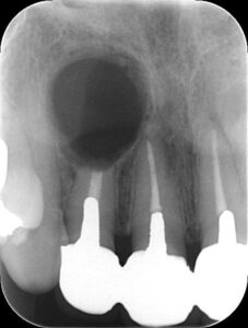 東京（江戸川区小岩）の根管治療専門外来｜笠原デンタルオフィスで、歯茎のデキモノ（サイナストラクト）は潰したら治る？自然に治る？サイナストラクトの危険性と正しい対処法について解説