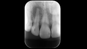 東京の根管治療専門外来、笠原デンタルオフィスで、「歯根破折」を放置するとどうなる？骨消失のリスクと、「精密診断」の重要性を専門医が解説