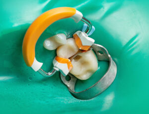 東京（江戸川区小岩）の根管治療専門外来｜笠原デンタルオフィスで、パーフォレーション（穿孔）」は根管治療の失敗！？原因と症状、対処法について解説