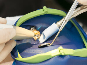 「根管治療後に薬の味がする」のは治療の失敗！？根管治療中の臭いと治療後の薬の漏れ、その原因と対処法