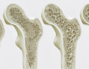更年期で歯がボロボロに？歯の痛み・歯ぐきの腫れ・歯の脆弱化の原因と治療法