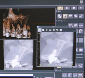 「根管治療後に薬の味がする」のは治療の失敗！？根管治療中の臭いと治療後の薬の漏れ、その原因と対処法