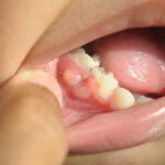 東京（江戸川区小岩）の根管治療専門外来｜笠原デンタルオフィスで、歯茎のデキモノ（フィステル）は潰したら治る？自然に治る？フィステルの危険性と正しい対処法について解説