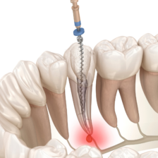 東京（江戸川区小岩）の根管治療専門外来｜笠原デンタルオフィスで、パーフォレーション（穿孔）」は根管治療の失敗！？原因と症状、対処法について解説