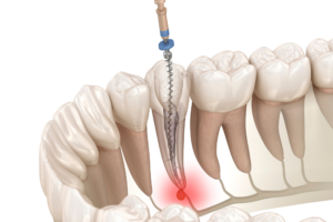 東京（江戸川区小岩）の根管治療専門外来｜笠原デンタルオフィスで、パーフォレーション（穿孔）」は根管治療の失敗！？原因と症状、対処法について解説