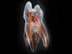 東京（江戸川区小岩）の根管治療専門外来｜笠原デンタルオフィスで、パーフォレーション（穿孔）」は根管治療の失敗！？原因と症状、対処法について解説