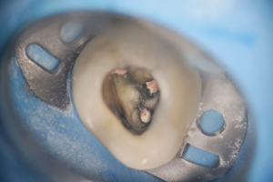 東京（江戸川区小岩）の根管治療専門外来｜笠原デンタルオフィスで、【根管治療中の偶発】折れたリーマー（ファイル）が根管内に残った！治療の失敗？原因と精密な除去・対処法を解説