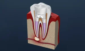 東京（江戸川区小岩）の根管治療専門外来｜笠原デンタルオフィスで、【根管治療10回以上の長期化】治らないのはなぜ？医院を変えるべき？「治らない根管」の原因解決策について解説