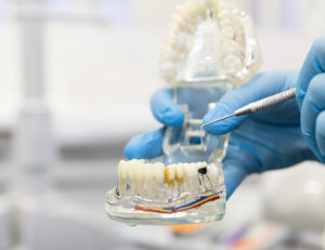 東京の根管治療専門外来、笠原デンタルオフィスで、「歯根破折」を放置するとどうなる？骨消失のリスクと、「精密診断」の重要性を専門医が解説