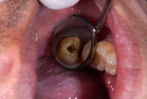 東京（江戸川区小岩）の根管治療専門外来｜笠原デンタルオフィスで、残せる歯・抜くべき歯の境界線と、抜歯宣告を覆す精密診断について解説