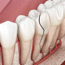 東京の根管治療専門外来、笠原デンタルオフィスで、歯が痛くて寝れない！薬も効かないのはもう手遅れ？激痛の正体と今すぐできる対処法について解説