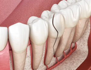 東京の根管治療専門外来、笠原デンタルオフィスで、「歯根破折」を放置するとどうなる？骨消失のリスクと、「精密診断」の重要性を専門医が解説