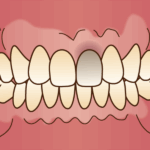 東京の根管治療専門外来、笠原デンタルオフィスで、神経を抜いた歯の変色はいつから？防げる？黒ずむ原因と対策について解説