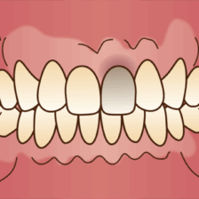 東京の根管治療専門外来、笠原デンタルオフィスで、神経を抜いた歯の変色はいつから？防げる？黒ずむ原因と対策について解説