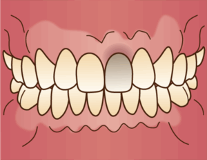 東京の根管治療専門外来、笠原デンタルオフィスで、神経を抜いた歯の変色はいつから？防げる？黒ずむ原因と対策について解説
