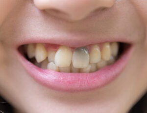 東京の根管治療専門外来、笠原デンタルオフィスで、神経を抜いた歯の変色はいつから？防げる？黒ずむ原因と対策について解説