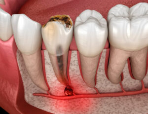 東京の根管治療専門外来、笠原デンタルオフィスで、「噛むと痛い」は歯根膜炎のサイン？神経を取ったはずの歯が痛む理由と対策を専門医が解説