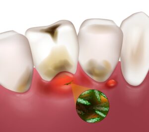 東京の根管治療専門外来、笠原デンタルオフィスで、「噛むと痛い」は歯根膜炎のサイン？神経を取ったはずの歯が痛む理由と対策を専門医が解説