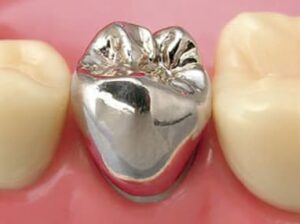 東京の根管治療専門外来、笠原デンタルオフィスで、根管治療後の再発リスクを下げる被せ物は？素材別の「平均寿命」と再発リスクについて解説