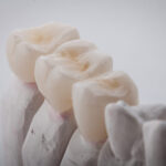 東京の根管治療専門外来、笠原デンタルオフィスで、根管治療後の再発リスクを下げる被せ物は？素材別の「平均寿命」と再発リスクについて解説