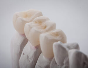 東京の根管治療専門外来、笠原デンタルオフィスで、根管治療後の再発リスクを下げる被せ物は？素材別の「平均寿命」と再発リスクについて解説