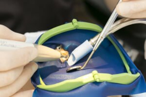 東京の根管治療専門外来、笠原デンタルオフィスで、「感染根管治療」って何？普通の根管治療と何が違うの？再発を繰り返す理由と、抜歯を回避する方法について解説