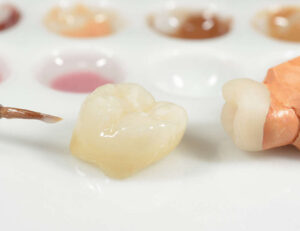 東京の根管治療専門外来、笠原デンタルオフィスで、根管治療後の再発リスクを下げる被せ物は？素材別の「平均寿命」と再発リスクについて解説