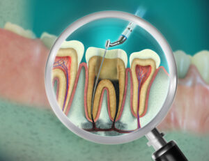 東京の根管治療専門外来、笠原デンタルオフィスで、「感染根管治療」って何？普通の根管治療と何が違うの？再発を繰り返す理由と、抜歯を回避する方法について解説
