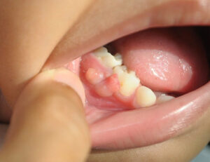 東京の根管治療専門外来、笠原デンタルオフィスで、歯の寿命を延ばす「MTAセメント」って何？失敗、後悔しないための基礎知識について解説