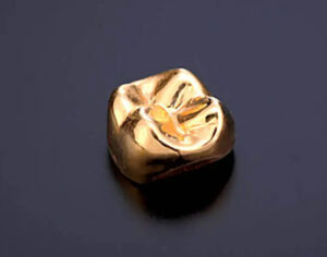 東京の根管治療専門外来、笠原デンタルオフィスで、根管治療後の再発リスクを下げる被せ物は？素材別の「平均寿命」と再発リスクについて解説