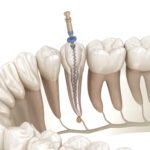 東京の根管治療専門外来、笠原デンタルオフィスで、「感染根管治療」って何？普通の根管治療と何が違うの？再発を繰り返す理由と、抜歯を回避する方法について解説