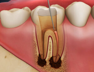 東京の根管治療専門外来、笠原デンタルオフィスで、「感染根管治療」って何？普通の根管治療と何が違うの？再発を繰り返す理由と、抜歯を回避する方法について解説