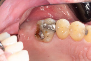 東京の根管治療専門外来、笠原デンタルオフィスで、根管治療後の再発リスクを下げる被せ物は？素材別の「平均寿命」と再発リスクについて解説