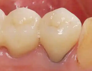 東京の根管治療専門外来、笠原デンタルオフィスで、根管治療後の再発リスクを下げる被せ物は？素材別の「平均寿命」と再発リスクについて解説