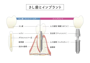 東京の根管治療専門外来、笠原デンタルオフィスで、歯牙移植後に「噛むと痛い」のは失敗？原因別の対処法について解説