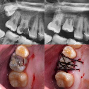 東京の根管治療専門外来、笠原デンタルオフィスで、歯牙移植後に「噛むと痛い」のは失敗？原因別の対処法について解説