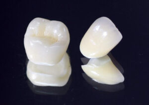 東京の根管治療専門外来、笠原デンタルオフィスで、根管治療後の再発リスクを下げる被せ物は？素材別の「平均寿命」と再発リスクについて解説