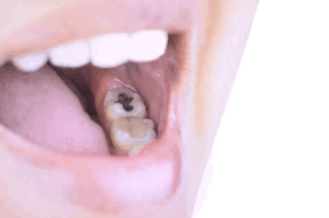 東京の根管治療専門外来、笠原デンタルオフィスで、銀歯は今は使われてない？残っている銀歯は変えなくてはだめ？取り替える見極め基準について解説