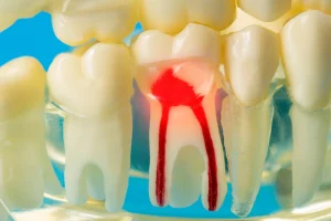 東京の根管治療専門外来、笠原デンタルオフィスで、歯が痛くて寝れない！薬も効かないのはもう手遅れ？激痛の正体と今すぐできる対処法について解説