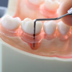 東京の根管治療専門外来、笠原デンタルオフィスで、歯周病なのに神経を抜く？「エンド・ペリオ病変」と、虫歯の根管治療との違いについて解説