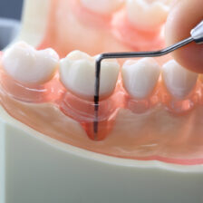 東京の根管治療専門外来、笠原デンタルオフィスで、歯周病なのに神経を抜く？「エンド・ペリオ病変」と、虫歯の根管治療との違いについて解説