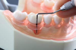 東京の根管治療専門外来、笠原デンタルオフィスで、歯周病なのに神経を抜く？「エンド・ペリオ病変」と、虫歯の根管治療との違いについて解説