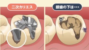 東京の根管治療専門外来、笠原デンタルオフィスで、「歯茎から腐ったような臭いがする」のは危険信号？原因別の臭いの特徴と治療法について解説