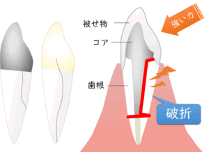 東京の根管治療専門外来、笠原デンタルオフィスで、「根っこしかない歯」は抜歯しかない？歯を残すための基準と治療法について解説