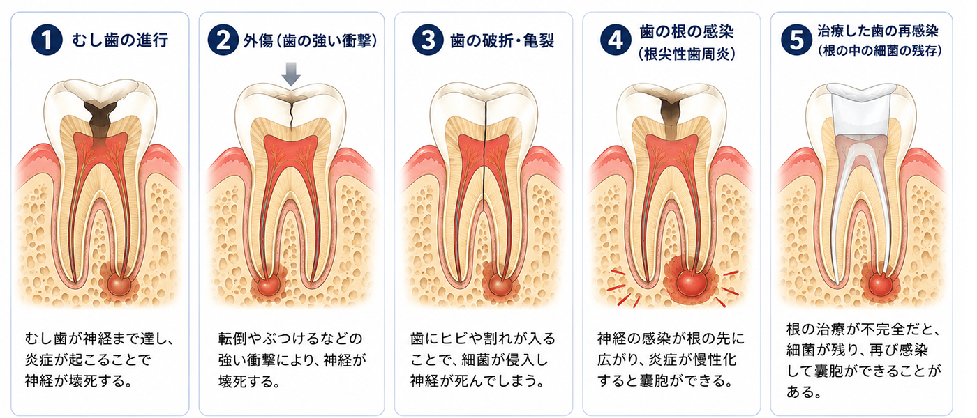 東京の根管治療専門外来、笠原デンタルオフィスで、歯根嚢胞（しこんのうほう）は自然に治る？放置するリスクと、抜歯を避けるための治療法を歯科医師が解説