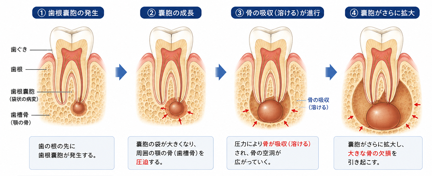 東京の根管治療専門外来、笠原デンタルオフィスで、歯根嚢胞（しこんのうほう）は自然に治る？放置するリスクと、抜歯を避けるための治療法を歯科医師が解説