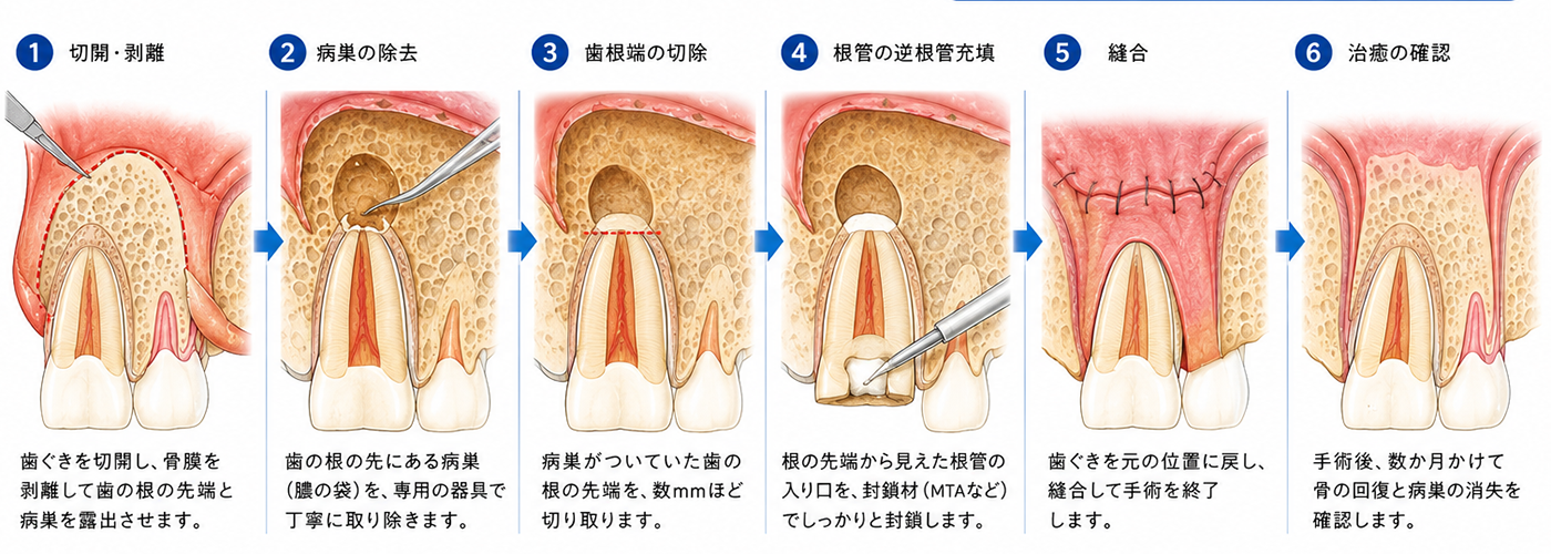東京の根管治療専門外来、笠原デンタルオフィスで、歯根嚢胞（しこんのうほう）は自然に治る？放置するリスクと、抜歯を避けるための治療法を歯科医師が解説