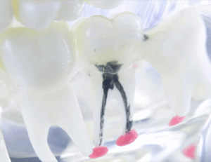 東京の根管治療専門外来、笠原デンタルオフィスで、歯の激痛が急に消えた！？歯髄壊死の見分け方と適切な治療アプローチ